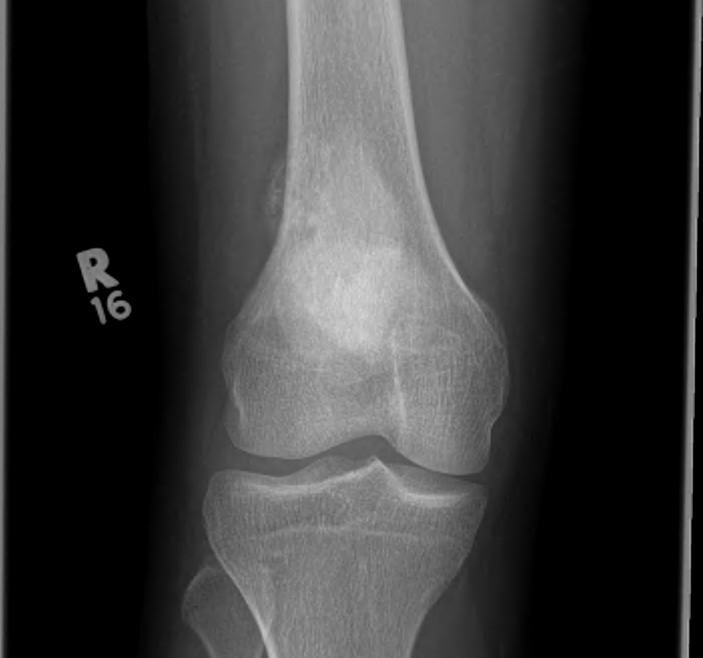 Parosteal Osteosarcoma Xray